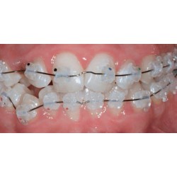 D.B. AESTHETIC BRACKETS KIT