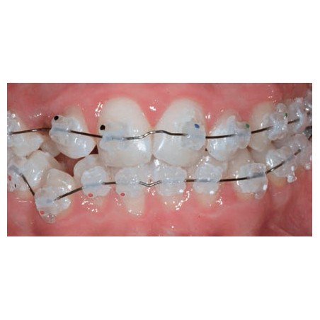 D.B. AESTHETIC BRACKETS KIT