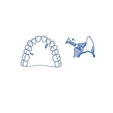 MICRO VITI A MOLLA KIT