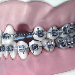 MOLLE APERTE 014 X 055