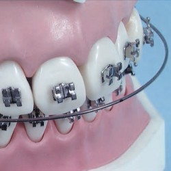 ARCHI NiTi Tondi Superiori e Inferiori forme small medium large