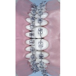 ARCHI NiTi V SUPERIORI E INFERIORI