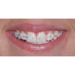 ATTACCHI D.B..022 CERAMICI 1pz