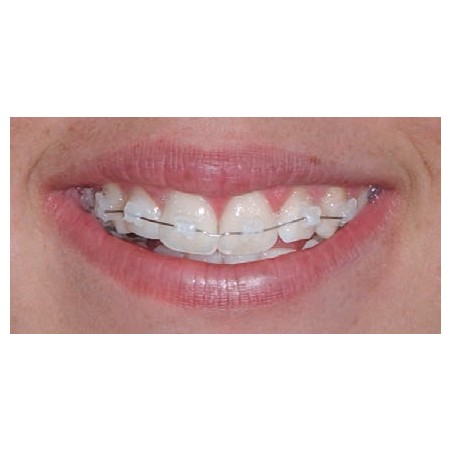 ATTACCHI D.B..022 CERAMICI 1pz